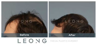 Hair Transplant Before & After Gallery - Patient 327416 - Image 6