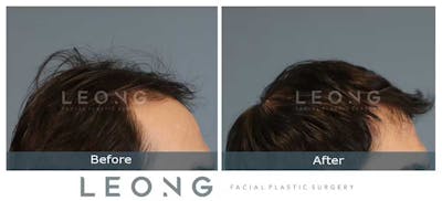 Hair Transplant Before & After Gallery - Patient 327416 - Image 4