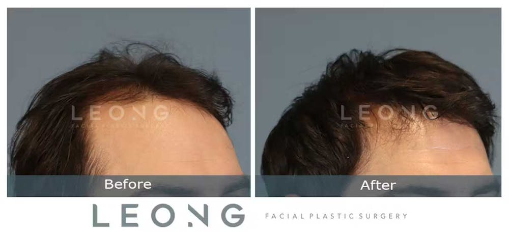 Hair Transplant Before & After Gallery - Patient 327416 - Image 3