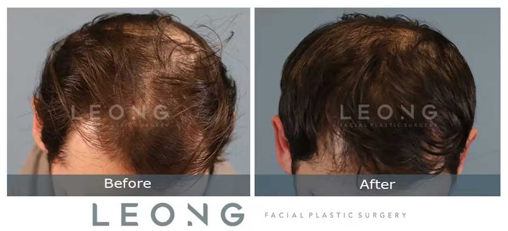 Hair Transplant Before & After Gallery - Patient 327416 - Image 5
