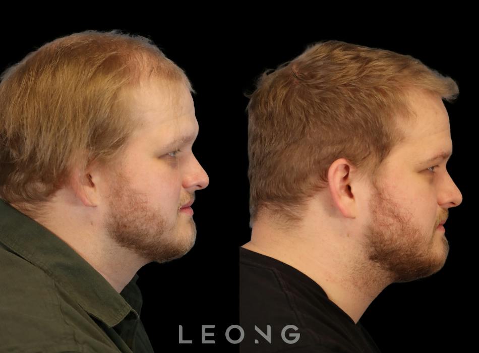 Before & After