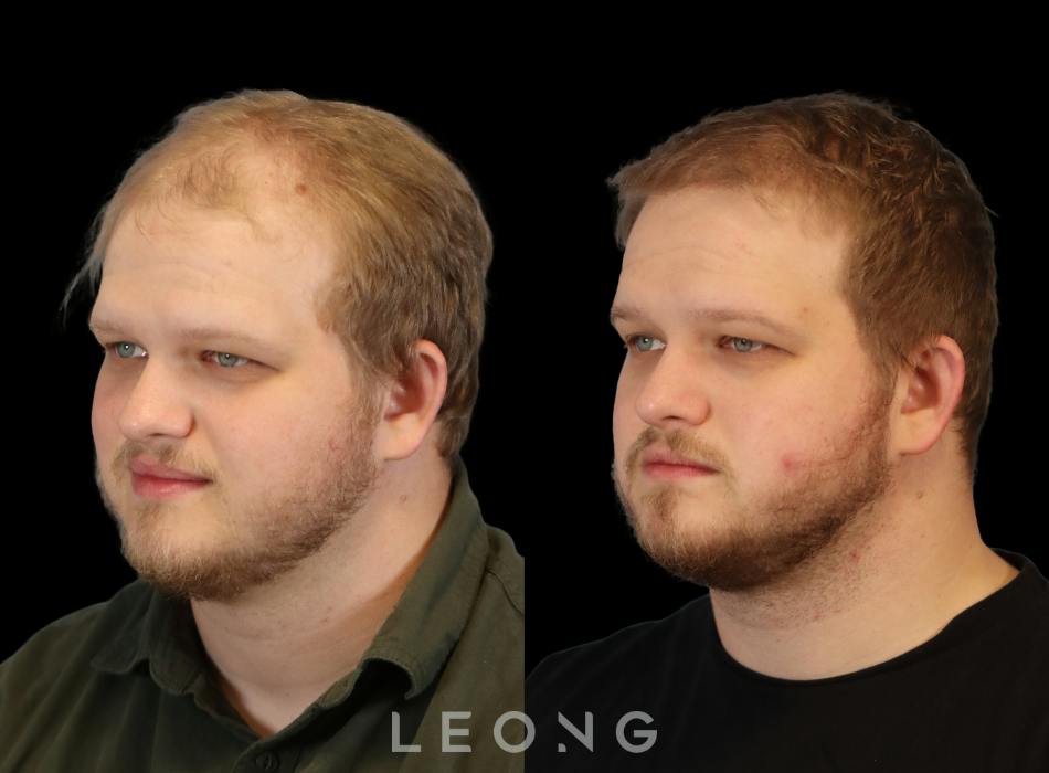 Before & After