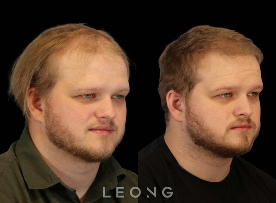 Before & After