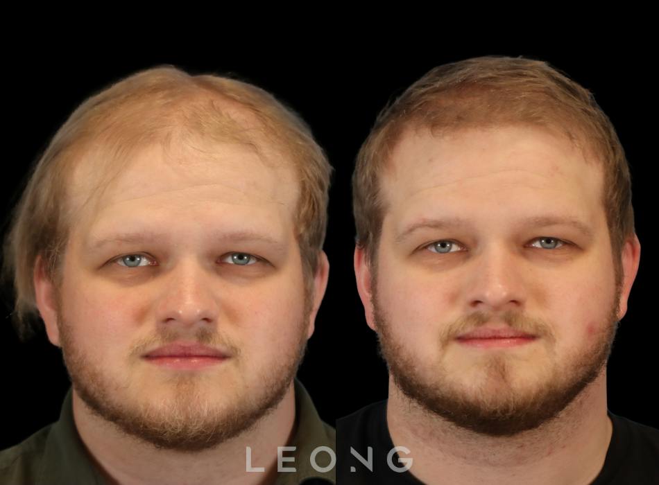 Before & After