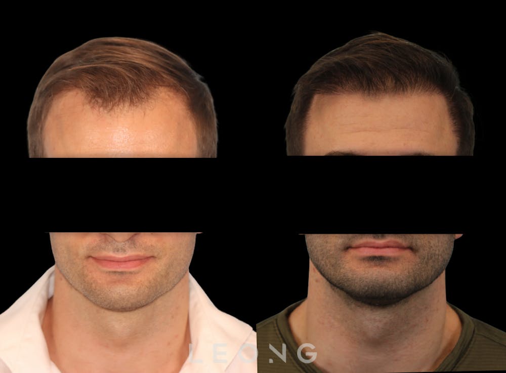 Hair Transplant Before & After Gallery - Patient 179984 - Image 1