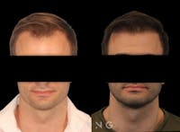Hair Transplant Before & After Gallery - Patient 179984 - Image 1