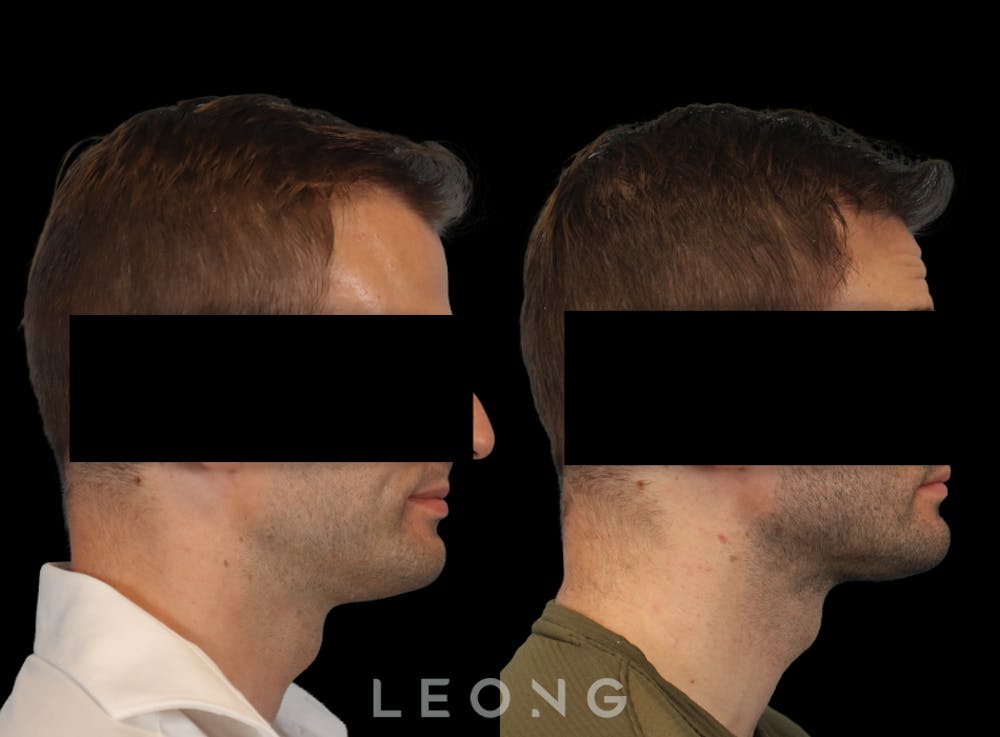 Hair Transplant Before & After Gallery - Patient 179984 - Image 3