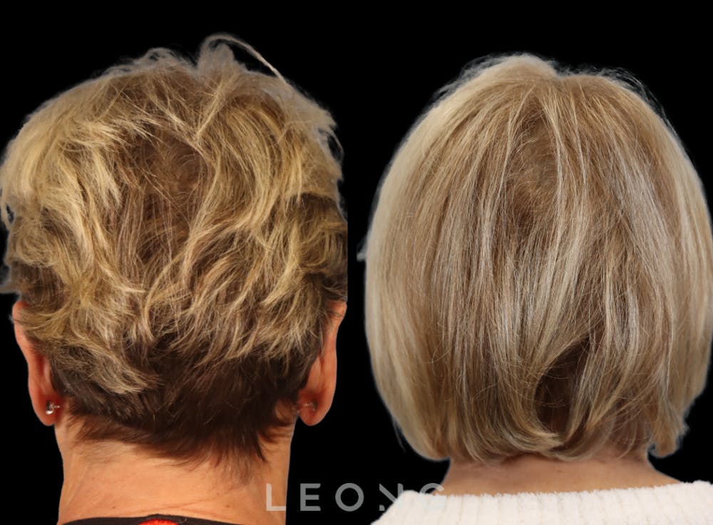 Hair Transplant Before & After Gallery - Patient 140932 - Image 7