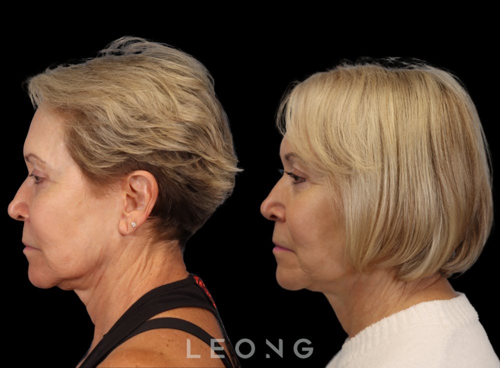 Hair Transplant Before & After Gallery - Patient 140932 - Image 5