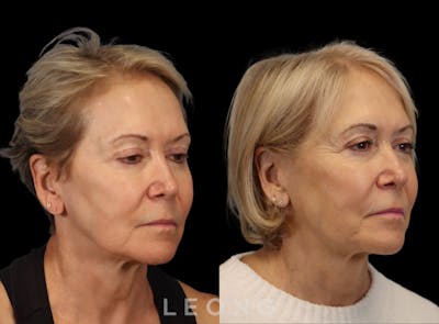 Hair Transplant Before & After Gallery - Patient 140932 - Image 4