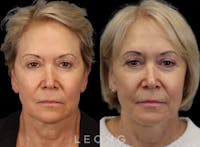 Hair Transplant Before & After Gallery - Patient 140932 - Image 1