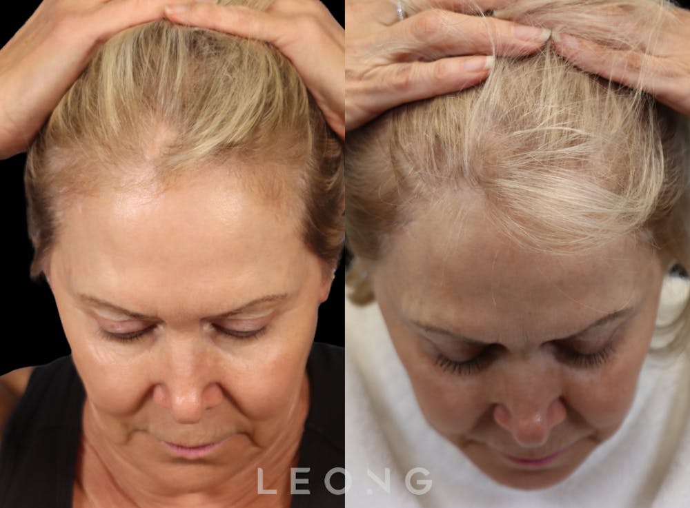 Hair Transplant Before & After Gallery - Patient 140932 - Image 6