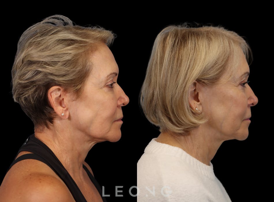 Hair Transplant Before & After Gallery - Patient 140932 - Image 3