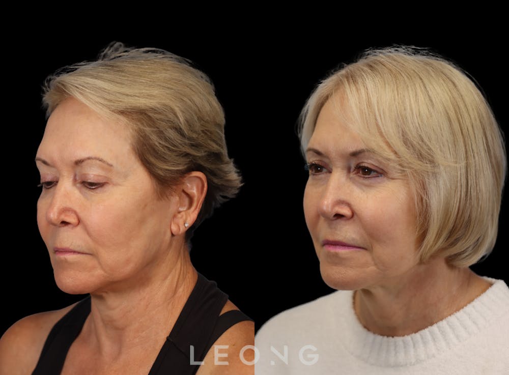 Hair Transplant Before & After Gallery - Patient 140932 - Image 2