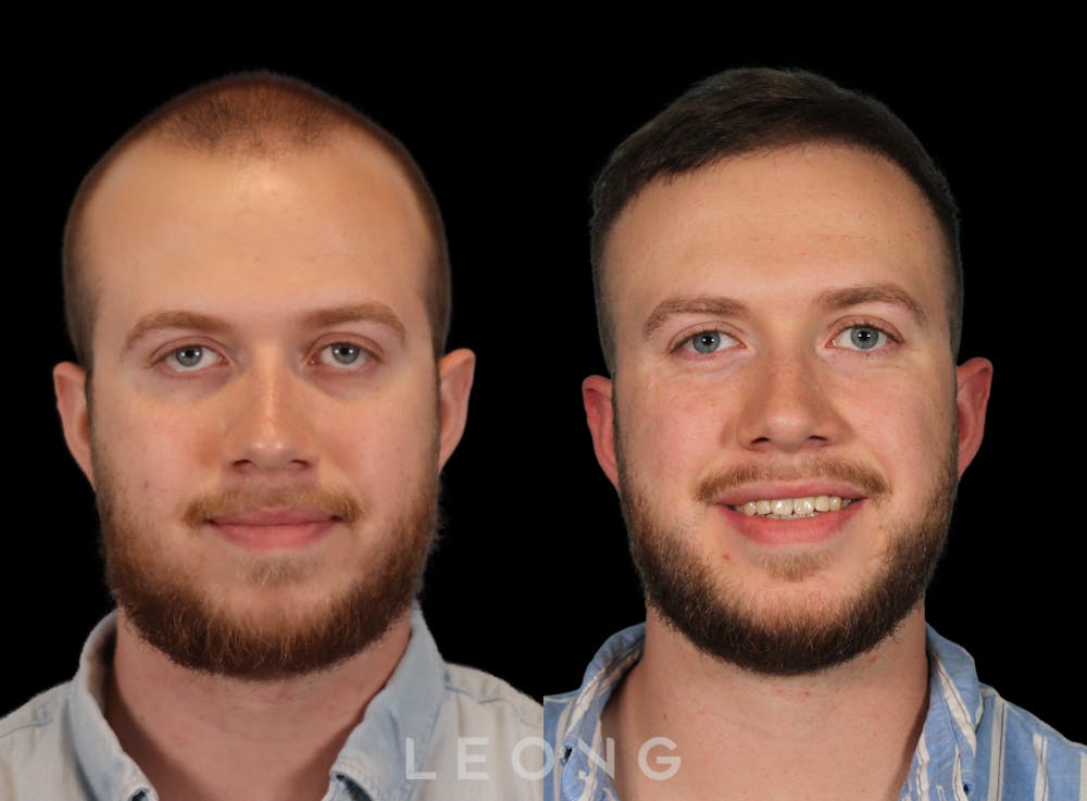 Hair Transplant Before & After Gallery - Patient 352449 - Image 3
