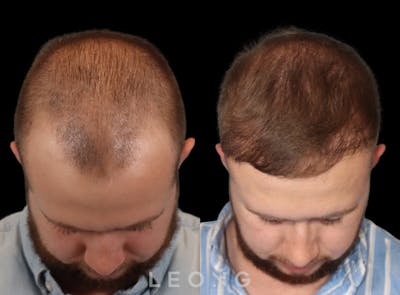 Hair Transplant Before & After Gallery - Patient 352449 - Image 2