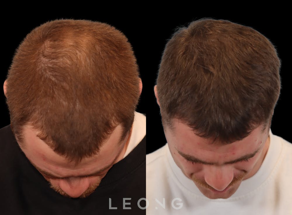 Hair Transplant Before & After Gallery - Patient 297008 - Image 2