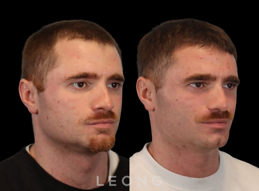 Hair Transplant Before & After Gallery - Patient 297008 - Image 3