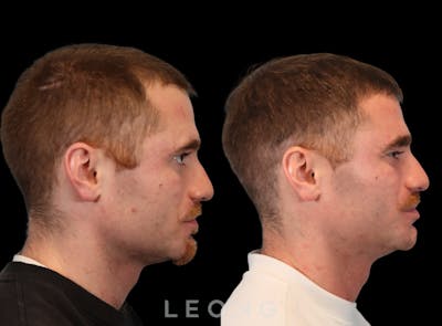 Hair Transplant Before & After Gallery - Patient 297008 - Image 4