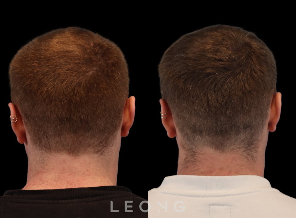 Hair Transplant Before & After Gallery - Patient 297008 - Image 7