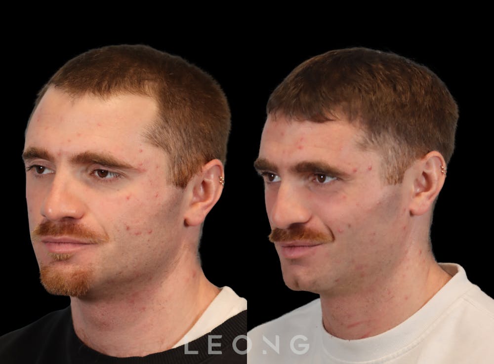 Hair Transplant Before & After Gallery - Patient 297008 - Image 6