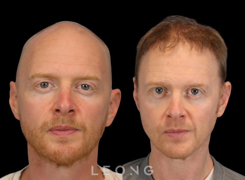 Hair Transplant Before & After Gallery - Patient 229259 - Image 1