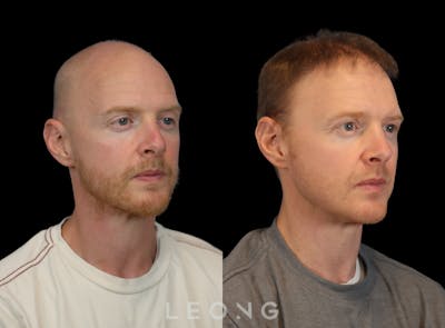 Hair Transplant Before & After Gallery - Patient 229259 - Image 4