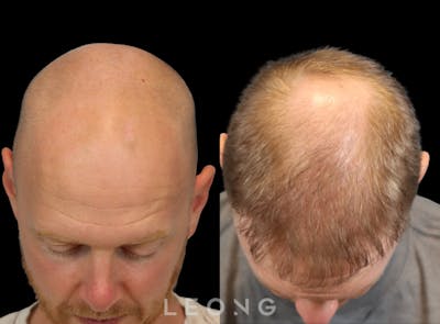 Hair Transplant Before & After Gallery - Patient 229259 - Image 6