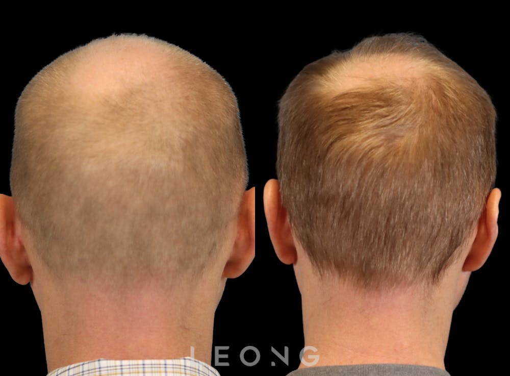 Hair Transplant Before & After Gallery - Patient 229259 - Image 7