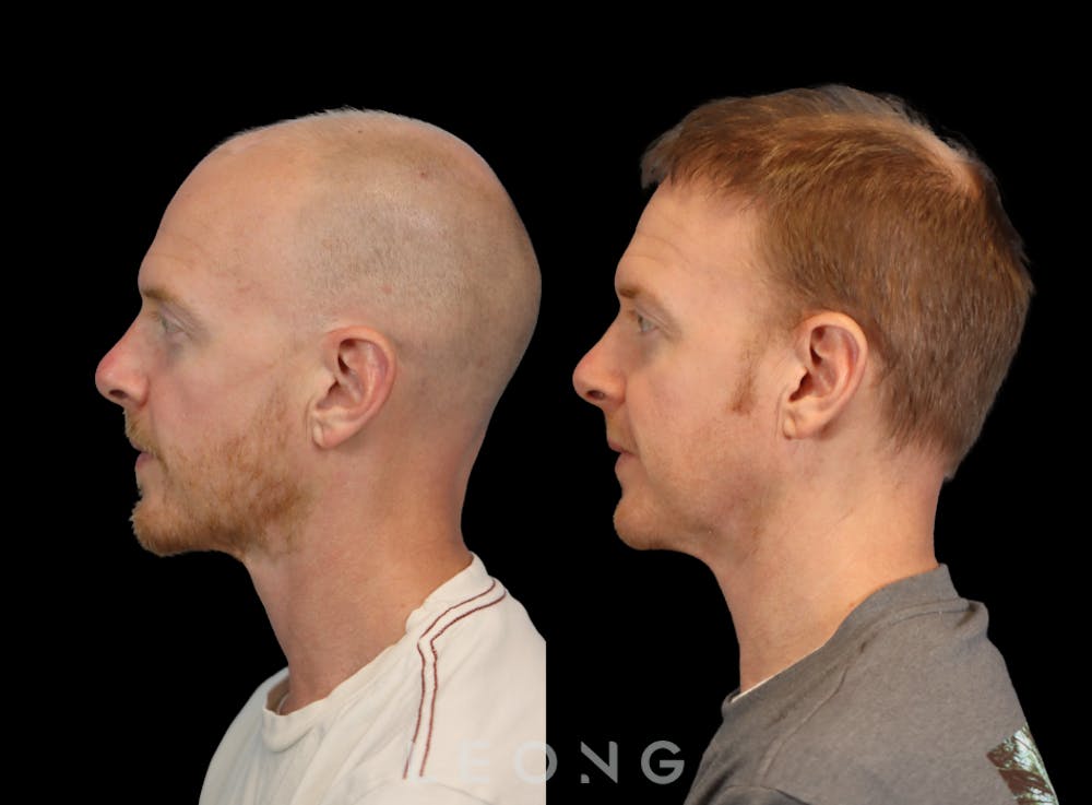 Hair Transplant Before & After Gallery - Patient 229259 - Image 3