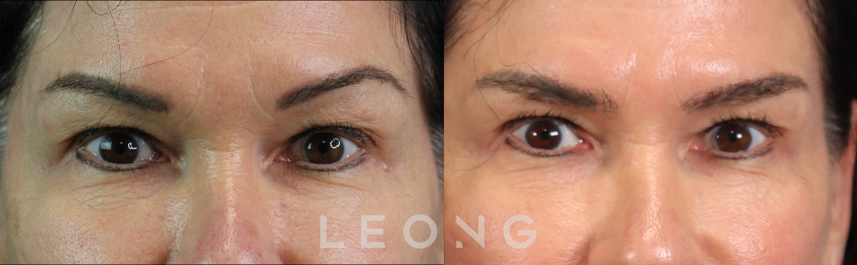 Before and After Photo