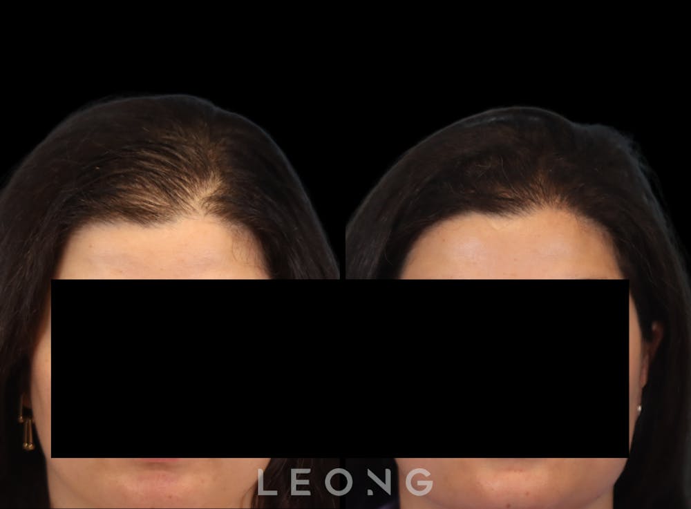 Hair Transplant Before & After Gallery - Patient 179305 - Image 1