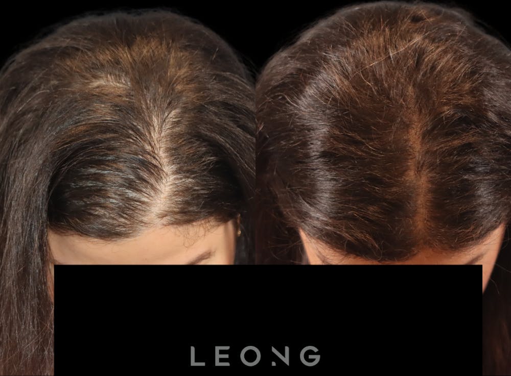 Hair Transplant Before & After Gallery - Patient 179305 - Image 2
