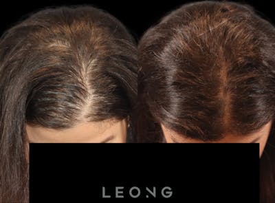 Hair Transplant Before & After Gallery - Patient 179305 - Image 2