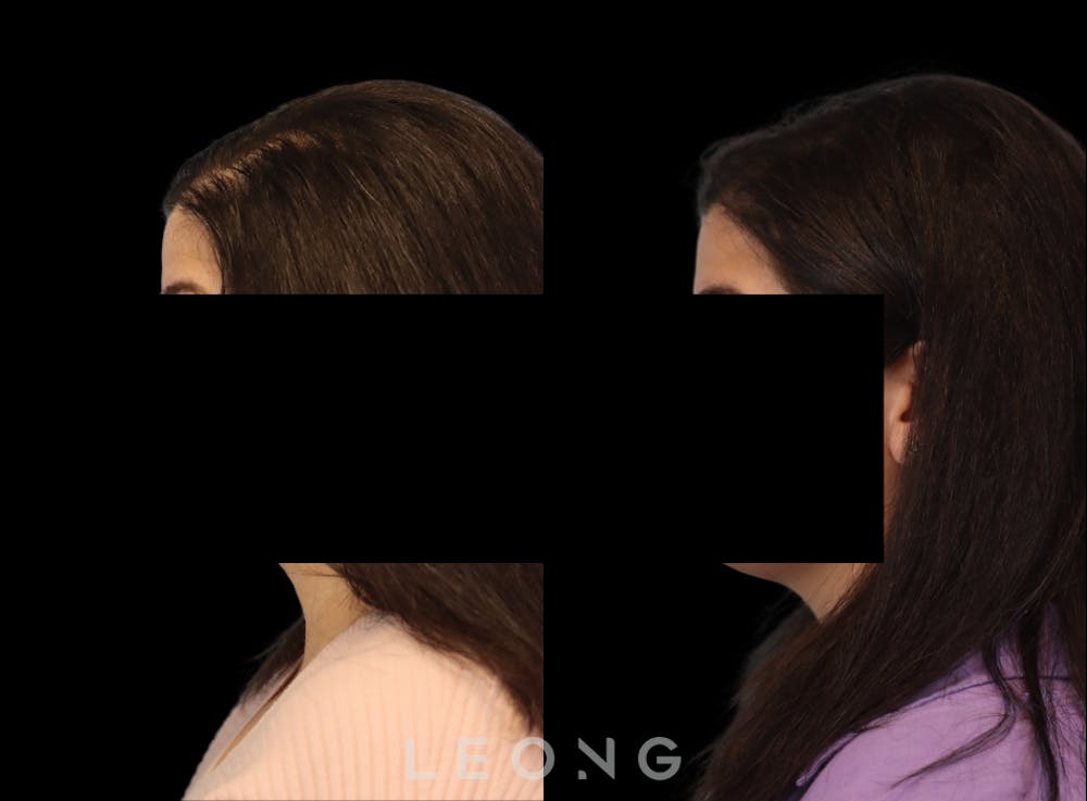 Hair Transplant Before & After Gallery - Patient 179305 - Image 5