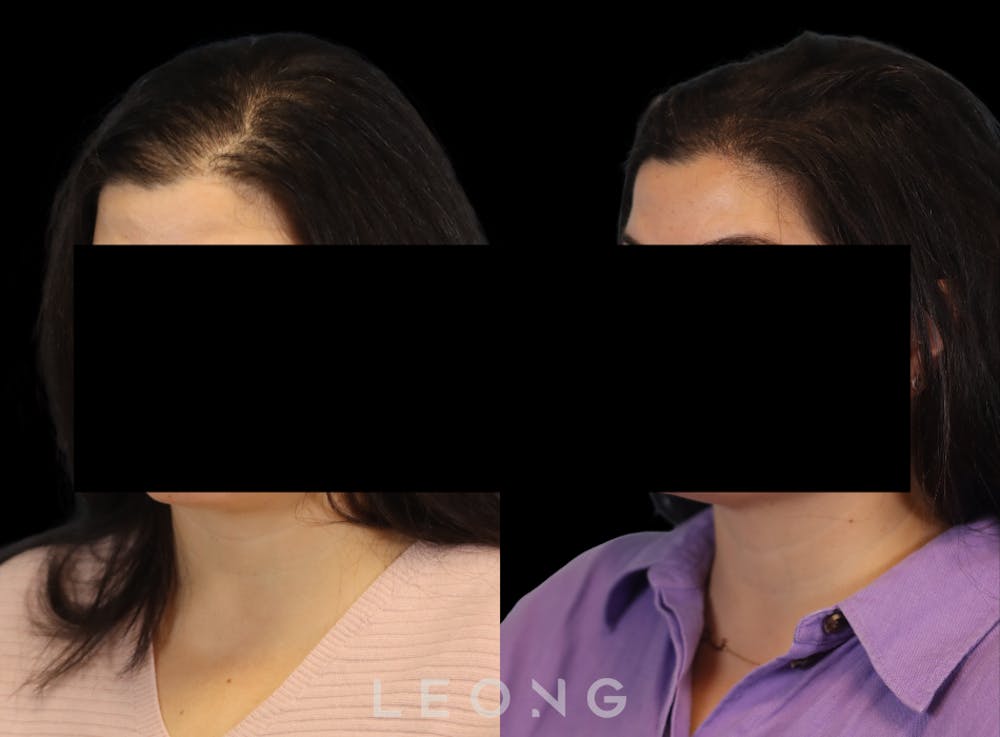 Hair Transplant Before & After Gallery - Patient 179305 - Image 4