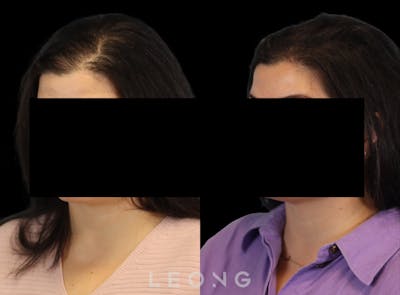 Hair Transplant Before & After Gallery - Patient 179305 - Image 4
