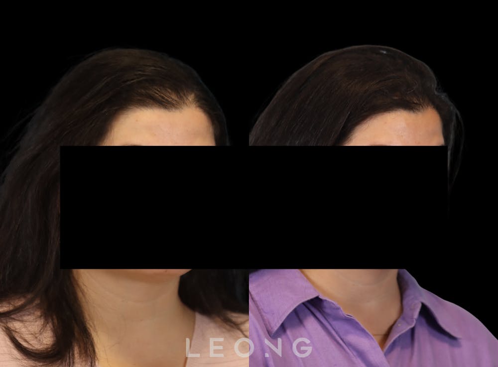 Hair Transplant Before & After Gallery - Patient 179305 - Image 3