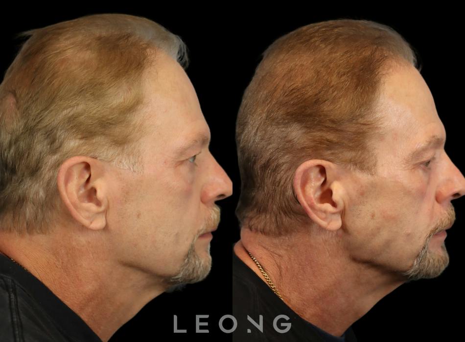 Before & After