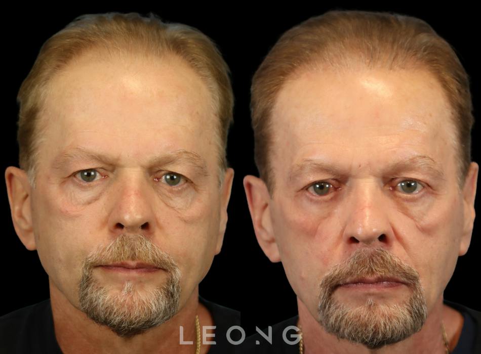 Before & After