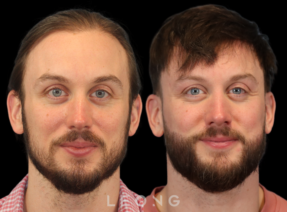 Hair Transplant