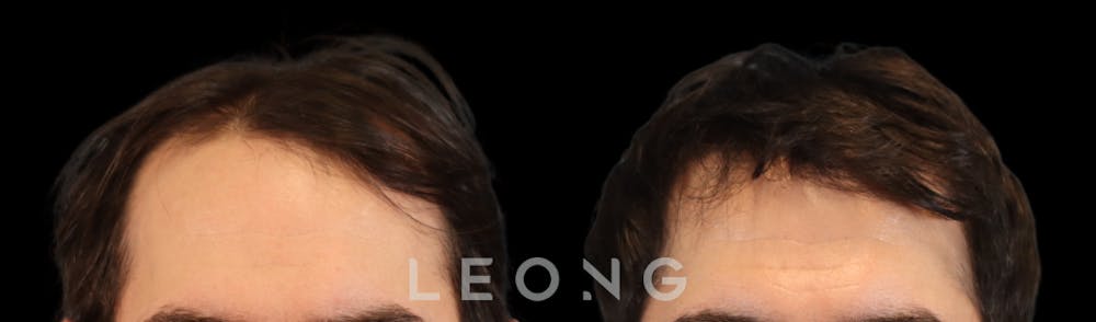 Hair Transplant Before & After Gallery - Patient 327416 - Image 1