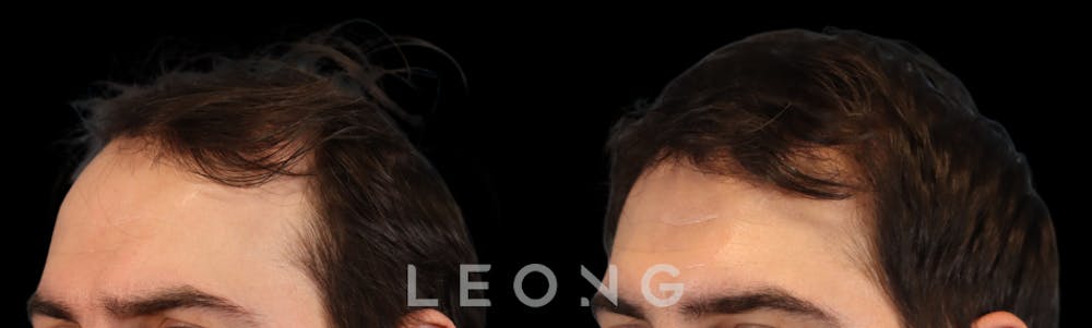 Hair Transplant Before & After Gallery - Patient 327416 - Image 2