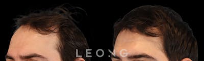 Hair Transplant Before & After Gallery - Patient 327416 - Image 2