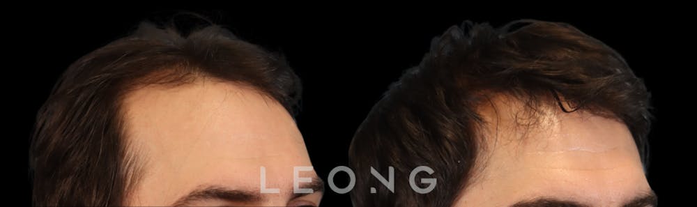 Hair Transplant Before & After Gallery - Patient 327416 - Image 3