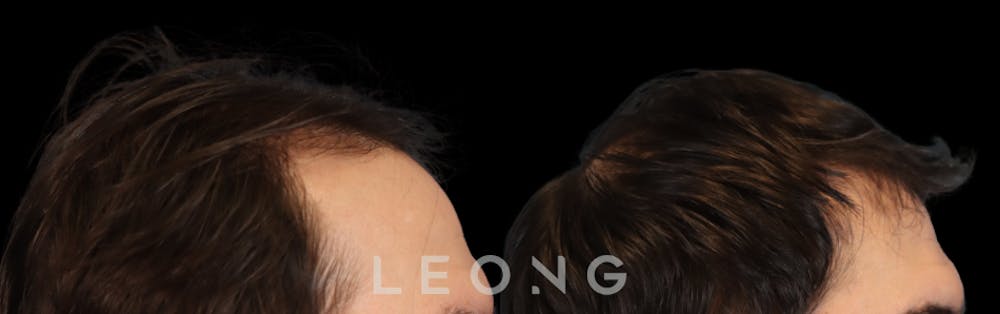 Hair Transplant Before & After Gallery - Patient 327416 - Image 4