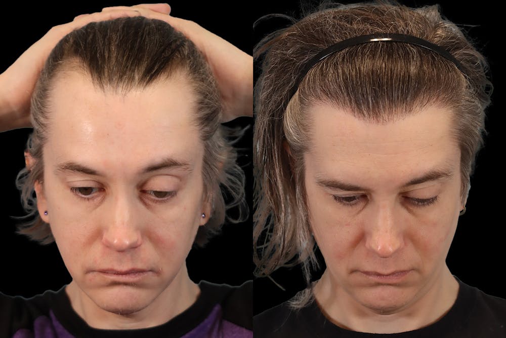 Hair Transplant Before & After Gallery - Patient 213293 - Image 2