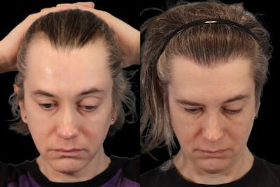 Hair Transplant Before & After Gallery - Patient 213293 - Image 2