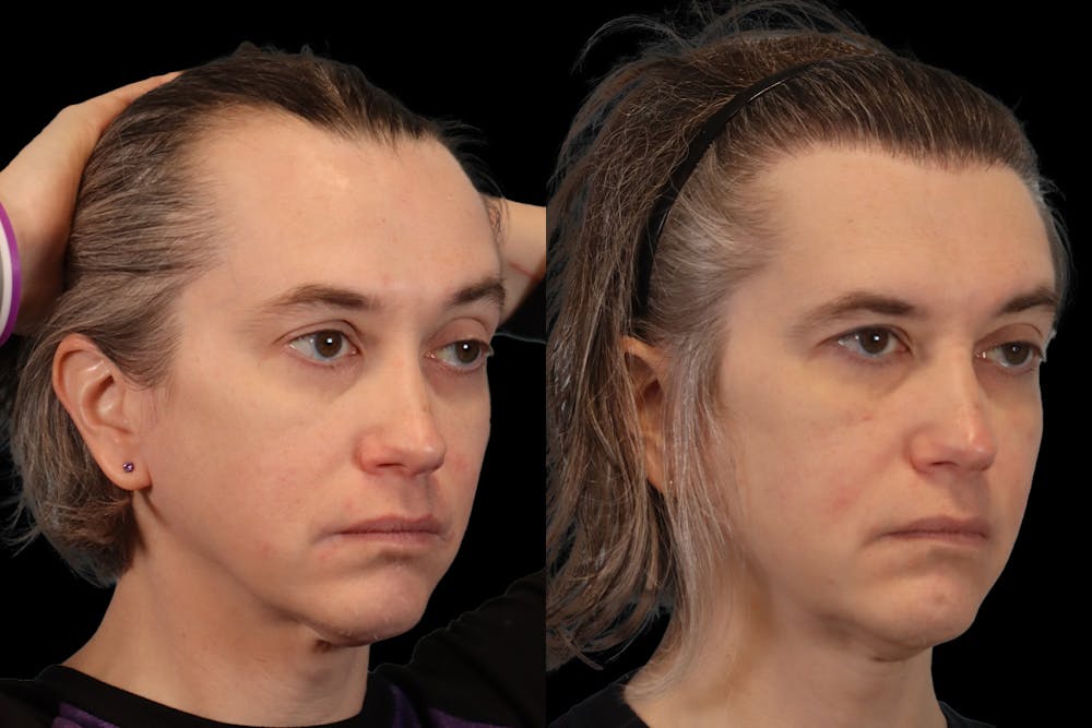 Hair Transplant Before & After Gallery - Patient 213293 - Image 3