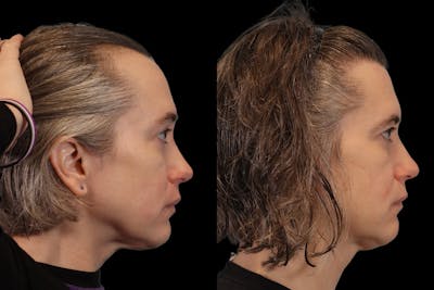 Hair Transplant Before & After Gallery - Patient 213293 - Image 4